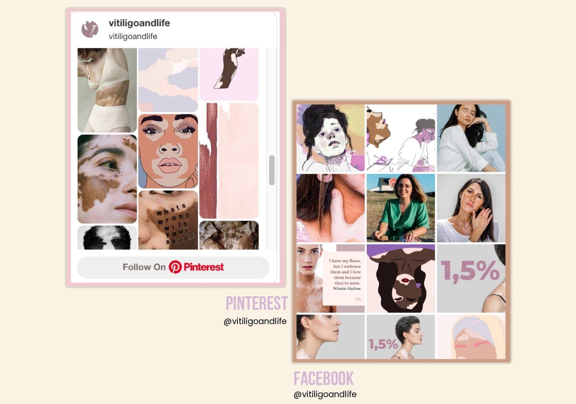 Galerie Instagram et Pinterest Vitiligo and Life