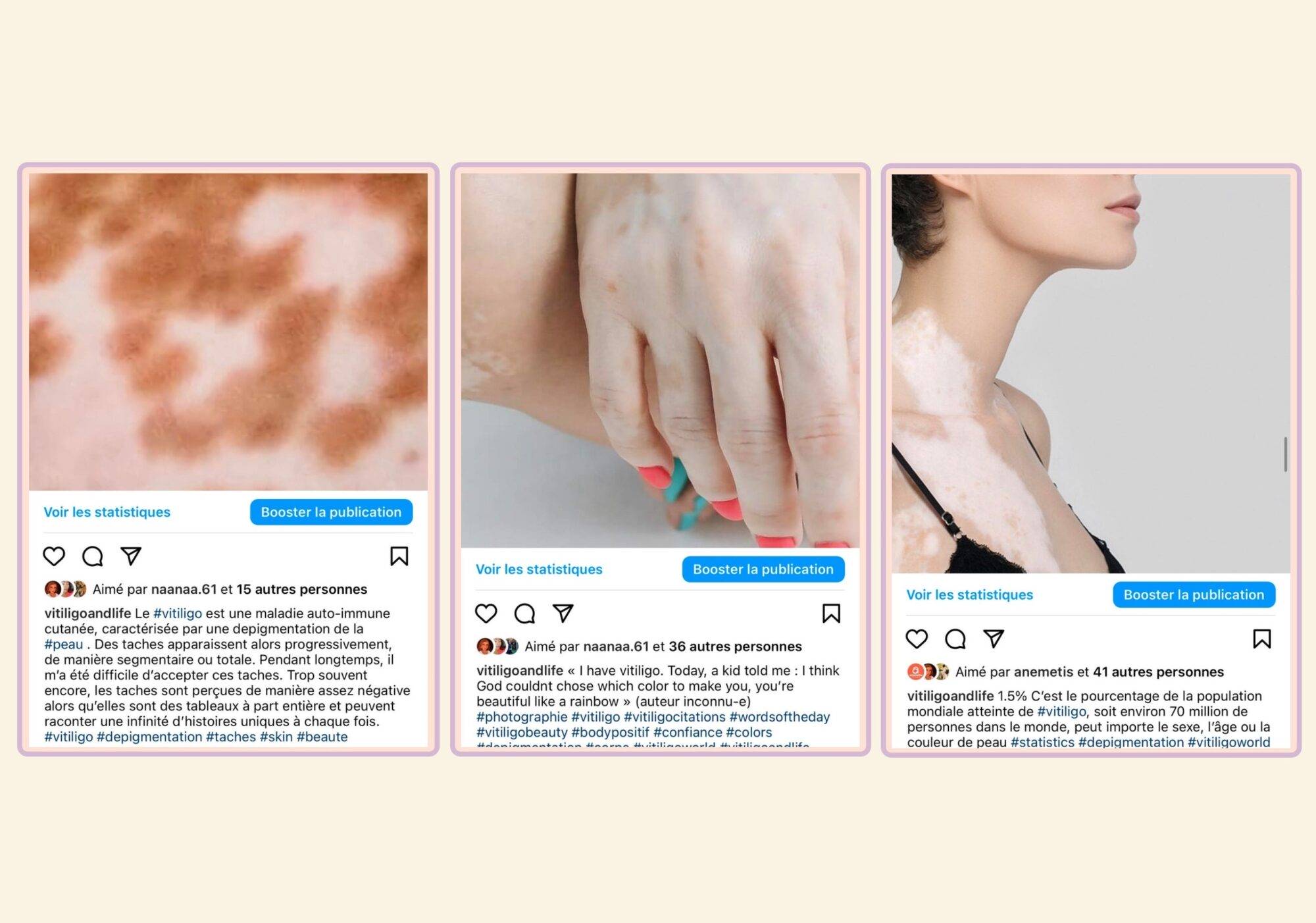 Publications Instagram Vitiligo and Life